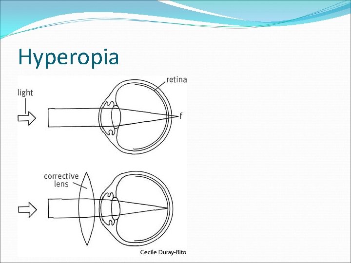 Hyperopia 