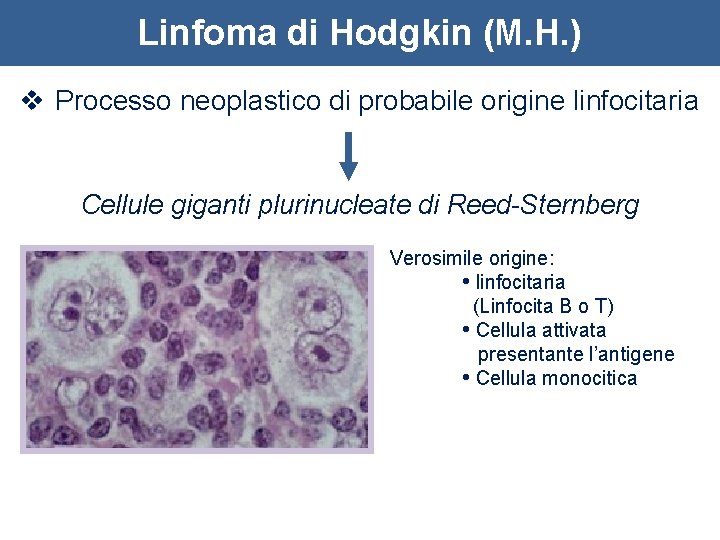 Linfoma di Hodgkin (M. H. ) v Processo neoplastico di probabile origine linfocitaria Cellule