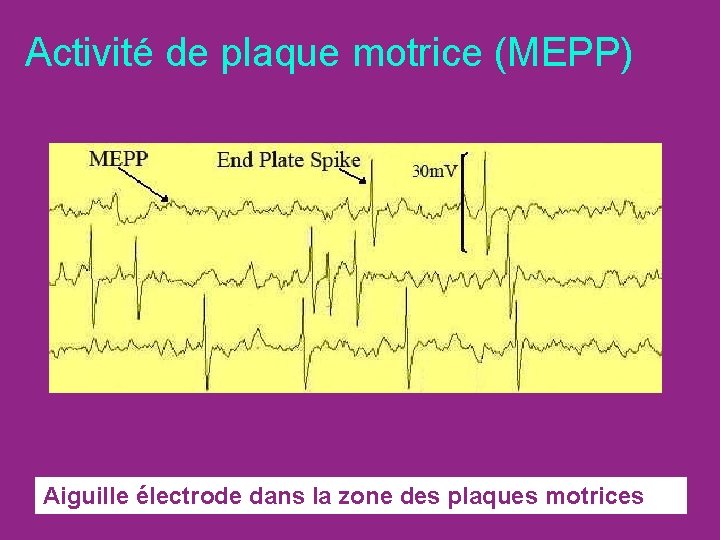 Activité de plaque motrice (MEPP) Aiguille électrode dans la zone des plaques motrices 
