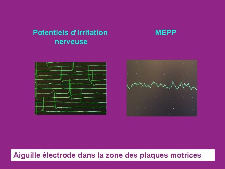 Potentiels d’irritation nerveuse MEPP Aiguille électrode dans la zone des plaques motrices 