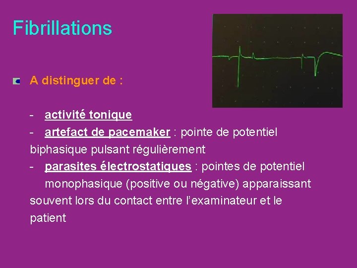 Fibrillations A distinguer de : - activité tonique - artefact de pacemaker : pointe