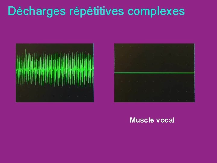Décharges répétitives complexes Muscle vocal 