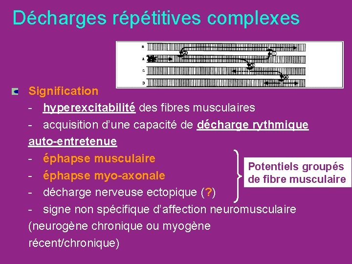 Décharges répétitives complexes Signification - hyperexcitabilité des fibres musculaires - acquisition d’une capacité de