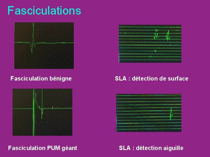 Fasciculations Fasciculation bénigne SLA : détection de surface Fasciculation PUM géant SLA : détection