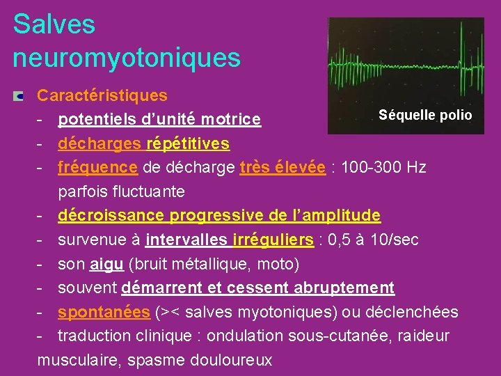 Salves neuromyotoniques Caractéristiques Séquelle polio - potentiels d’unité motrice - décharges répétitives - fréquence