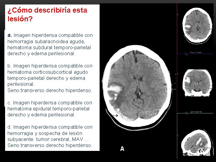 ¿Cómo describiría esta lesión? a. Imagen hiperdensa compatible con • hemorragia Mujer desubaracnoidea 18