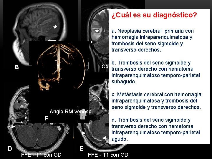 ¿Cuál es su diagnóstico? * ← B → C Sagital T 1 Angio RM