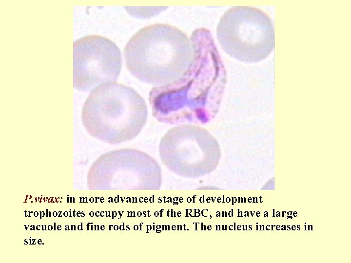 P. vivax: in more advanced stage of development trophozoites occupy most of the RBC,