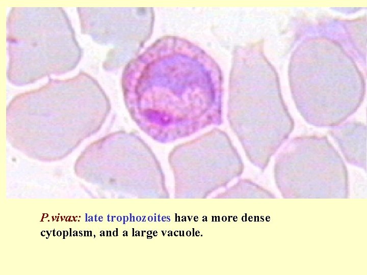 P. vivax: late trophozoites have a more dense cytoplasm, and a large vacuole. 
