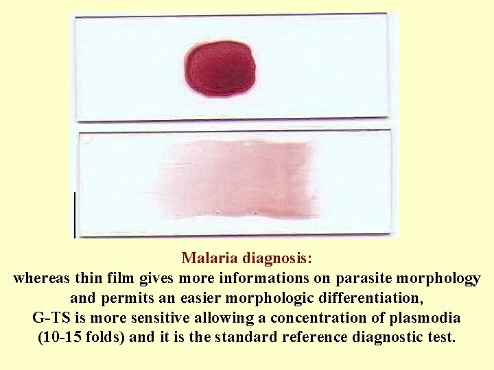 Malaria diagnosis: whereas thin film gives more informations on parasite morphology and permits an