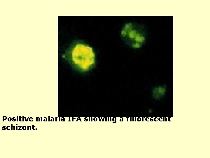 Positive malaria IFA showing a fluorescent schizont. 