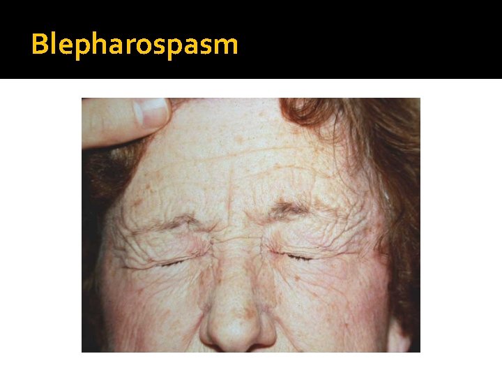 Blepharospasm 
