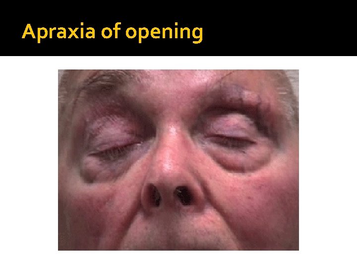 Apraxia of opening 