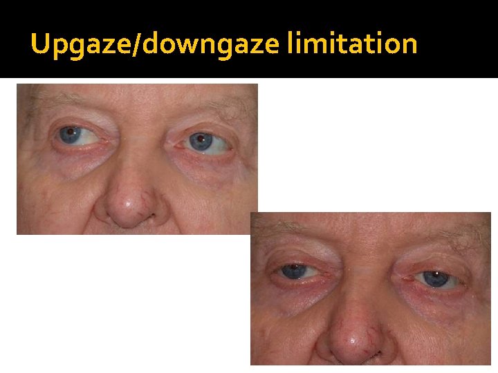 Upgaze/downgaze limitation 