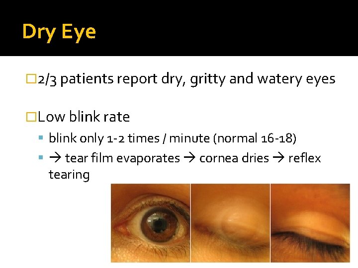 Dry Eye � 2/3 patients report dry, gritty and watery eyes �Low blink rate