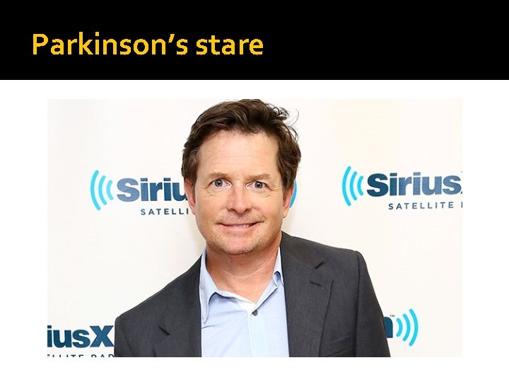 Parkinson’s stare 