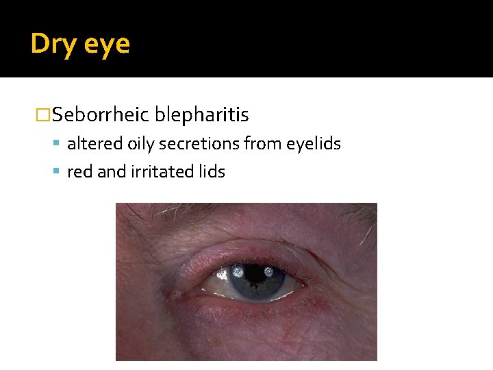 Dry eye �Seborrheic blepharitis altered oily secretions from eyelids red and irritated lids 