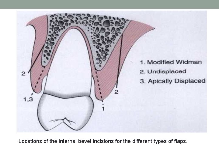 Locations of the internal bevel incisions for the different types of flaps. 