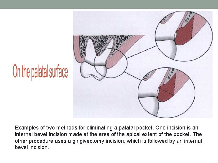Examples of two methods for eliminating a palatal pocket. One incision is an internal