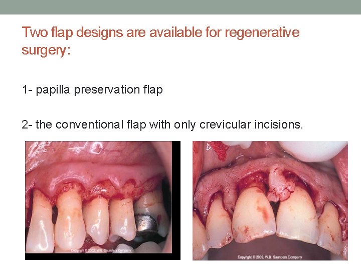 Two flap designs are available for regenerative surgery: 1 - papilla preservation flap 2