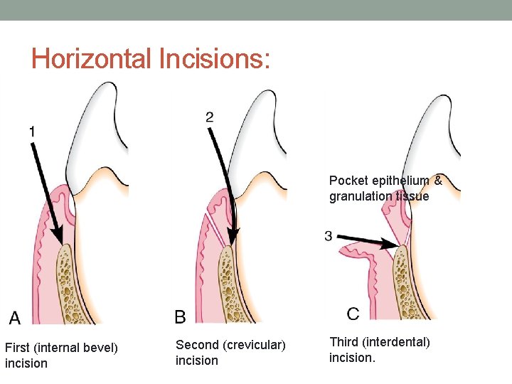 Horizontal Incisions: Pocket epithelium & granulation tissue First (internal bevel) incision Second (crevicular) incision