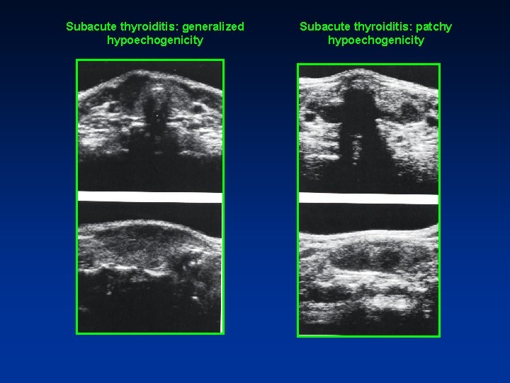 Subacute thyroiditis: generalized hypoechogenicity Subacute thyroiditis: patchy hypoechogenicity Subacute thyroiditis: generalized hypoechogenicity Subacute thyroiditis: patchy hypoechogenicity