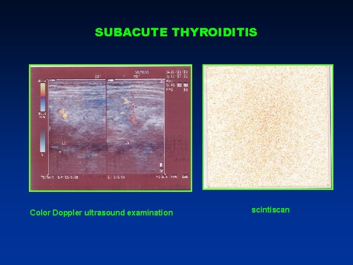 SUBACUTE THYROIDITIS Color Doppler ultrasound examination scintiscan SUBACUTE THYROIDITIS Color Doppler ultrasound examination scintiscan