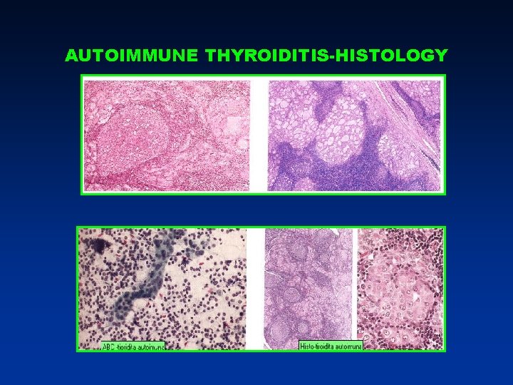 AUTOIMMUNE THYROIDITIS-HISTOLOGY AUTOIMMUNE THYROIDITIS-HISTOLOGY