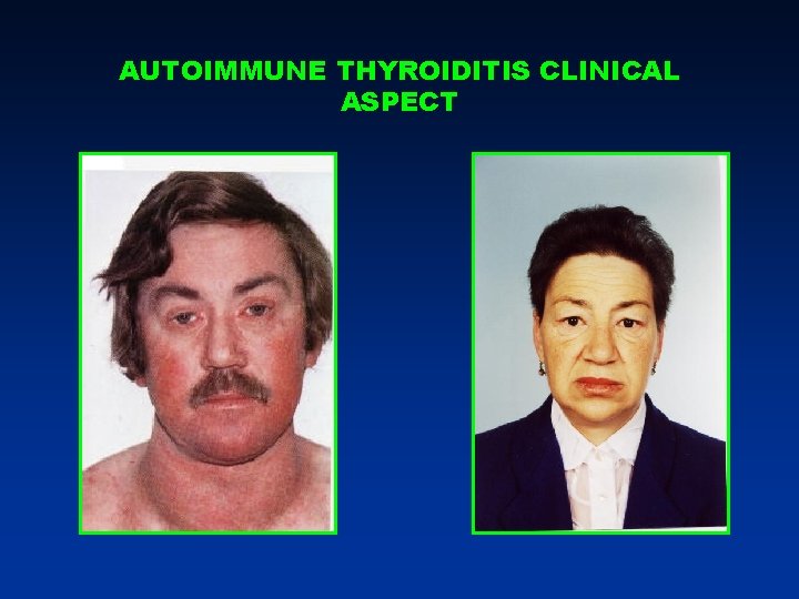 AUTOIMMUNE THYROIDITIS CLINICAL ASPECT AUTOIMMUNE THYROIDITIS CLINICAL ASPECT