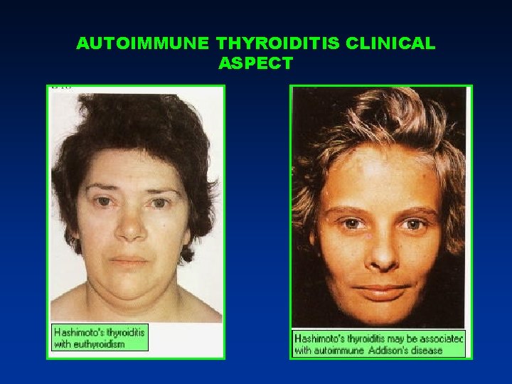 AUTOIMMUNE THYROIDITIS CLINICAL ASPECT AUTOIMMUNE THYROIDITIS CLINICAL ASPECT
