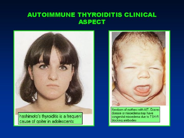 AUTOIMMUNE THYROIDITIS CLINICAL ASPECT AUTOIMMUNE THYROIDITIS CLINICAL ASPECT