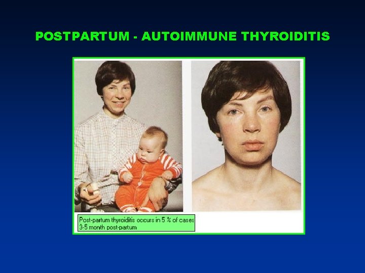POSTPARTUM - AUTOIMMUNE THYROIDITIS POSTPARTUM - AUTOIMMUNE THYROIDITIS