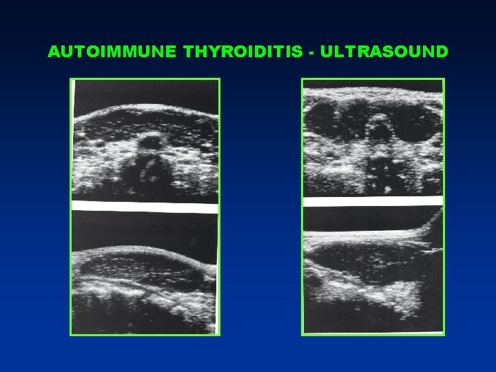 AUTOIMMUNE THYROIDITIS - ULTRASOUND AUTOIMMUNE THYROIDITIS - ULTRASOUND