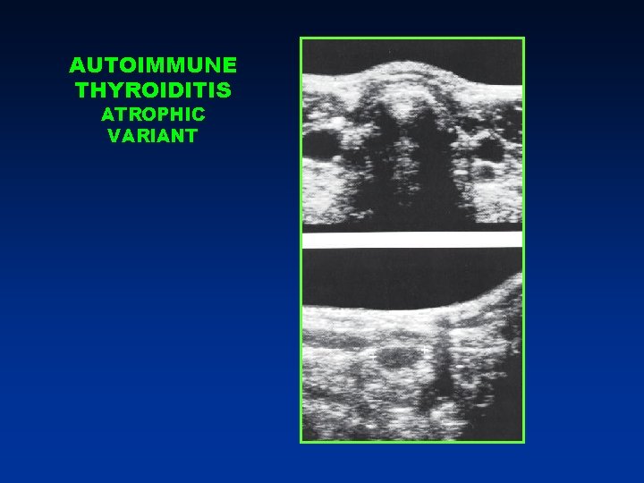AUTOIMMUNE THYROIDITIS ATROPHIC VARIANT AUTOIMMUNE THYROIDITIS ATROPHIC VARIANT