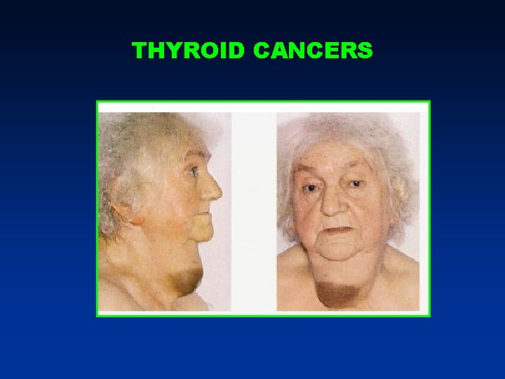 THYROID CANCERS THYROID CANCERS