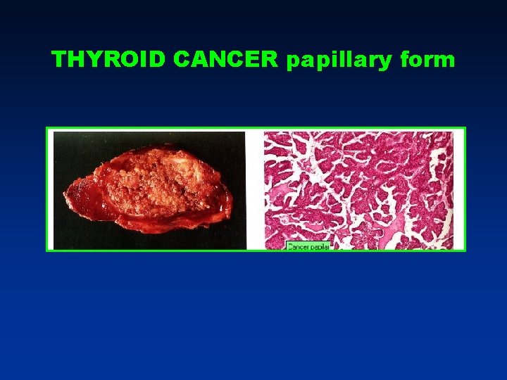 THYROID CANCER papillary form THYROID CANCER papillary form