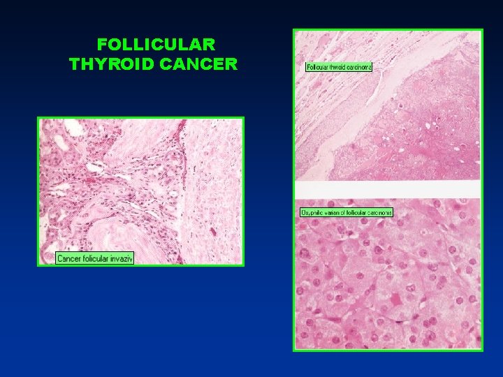 FOLLICULAR THYROID CANCER FOLLICULAR THYROID CANCER