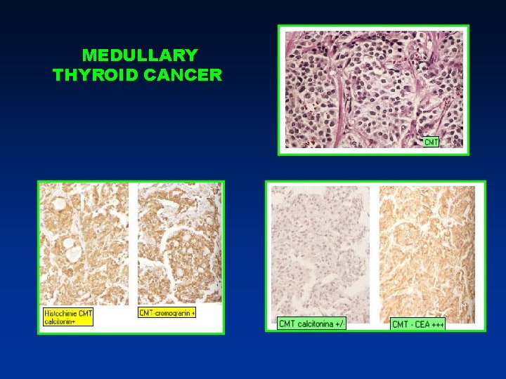 MEDULLARY THYROID CANCER MEDULLARY THYROID CANCER