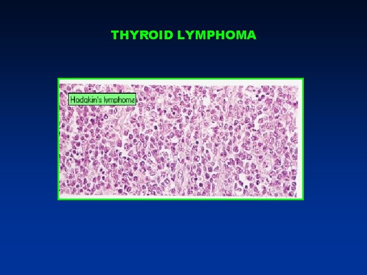 THYROID LYMPHOMA THYROID LYMPHOMA