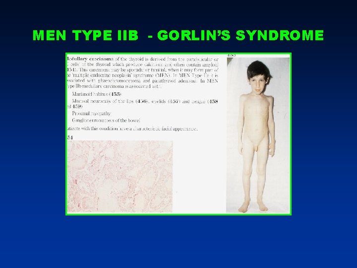 MEN TYPE IIB - GORLIN’S SYNDROME MEN TYPE IIB - GORLIN’S SYNDROME
