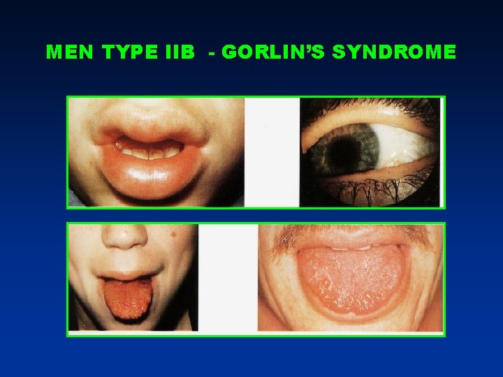 MEN TYPE IIB - GORLIN’S SYNDROME MEN TYPE IIB - GORLIN’S SYNDROME