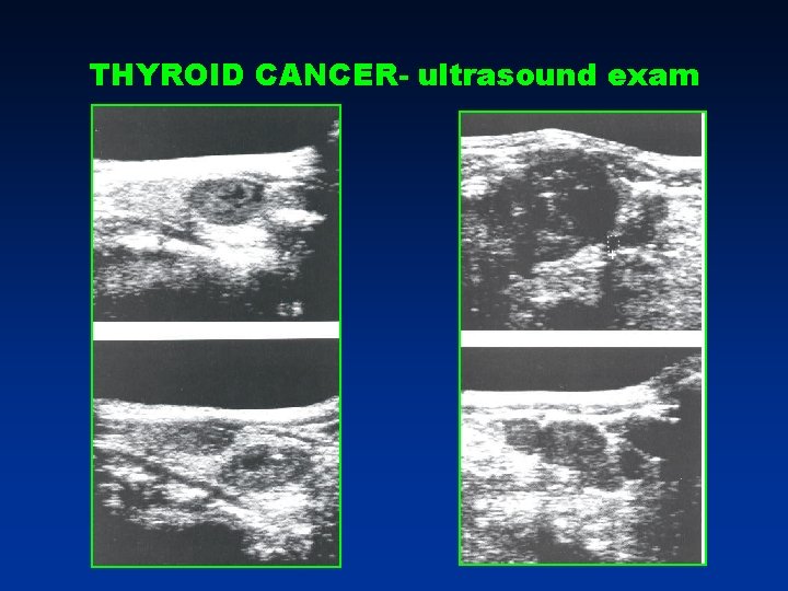 THYROID CANCER- ultrasound exam THYROID CANCER- ultrasound exam