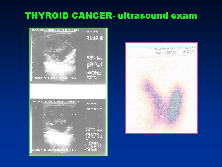 THYROID CANCER- ultrasound exam THYROID CANCER- ultrasound exam