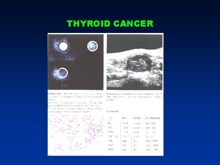 THYROID CANCER THYROID CANCER