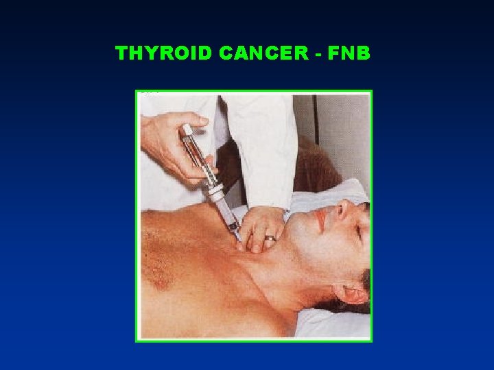 THYROID CANCER - FNB THYROID CANCER - FNB
