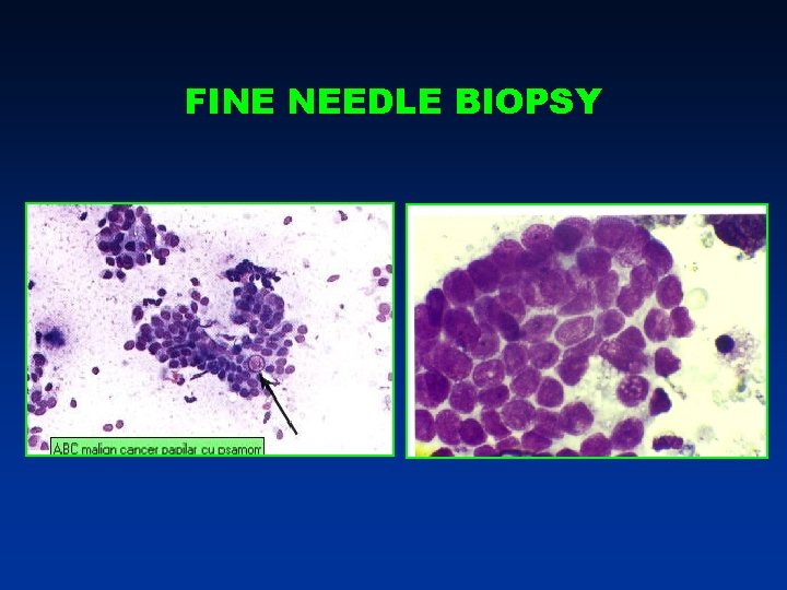 FINE NEEDLE BIOPSY FINE NEEDLE BIOPSY