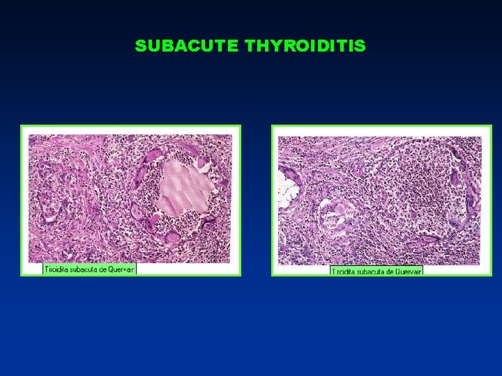 SUBACUTE THYROIDITIS SUBACUTE THYROIDITIS
