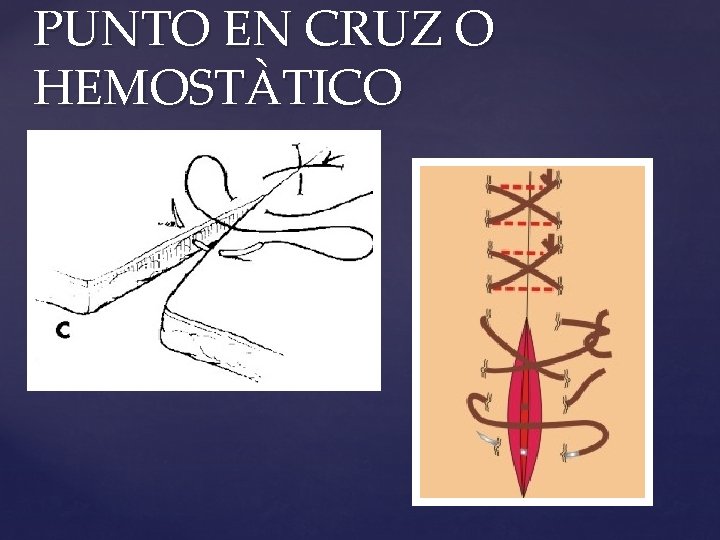 PUNTO EN CRUZ O HEMOSTÀTICO 