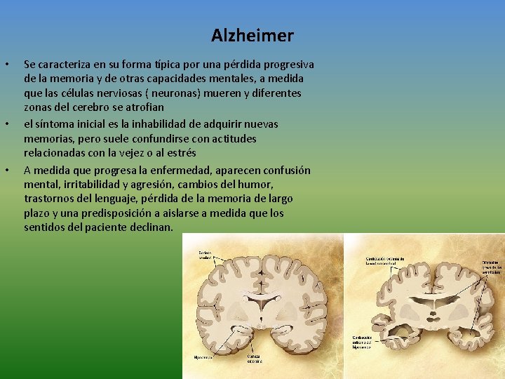 Alzheimer • • • Se caracteriza en su forma típica por una pérdida progresiva