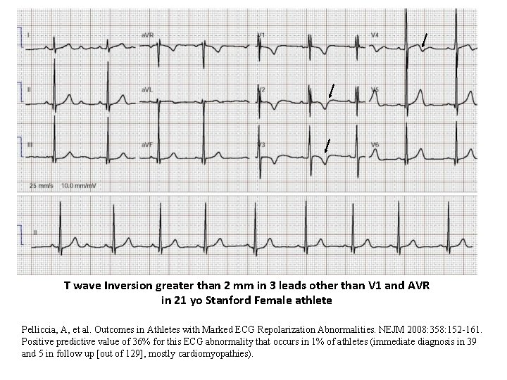 T wave Inversion greater than 2 mm in 3 leads other than V 1